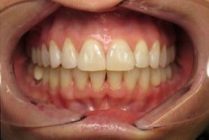 A patient's smile after Invisalign