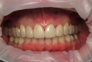 After image of teeth whitening of a nice beautiful white smile