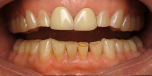 Image of smile with teeth ground down to poor jaw and bite alignment