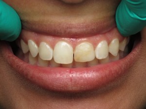 Before image of off-white and misshapen front teeth