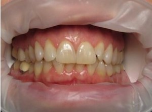 A patient's smile before Invisalign