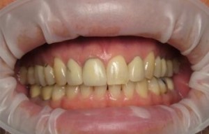 Before image of teeth whitening of yellow teeth